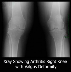 Arthritus-Knee