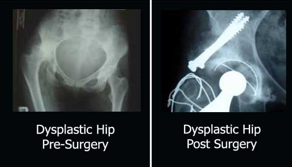 Hip-Dysplasia-Operation