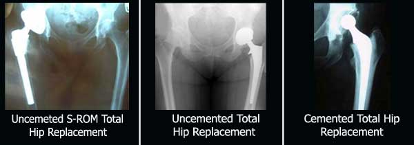 total-hip-replacement